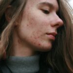 Démangeaisons de la peau : comprendre les causes et soulager efficacement