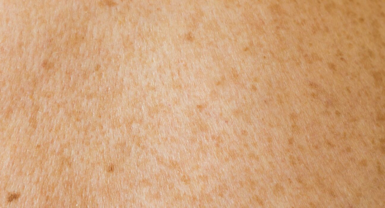 un gros plan du dos d’une personne avec des taches brunes