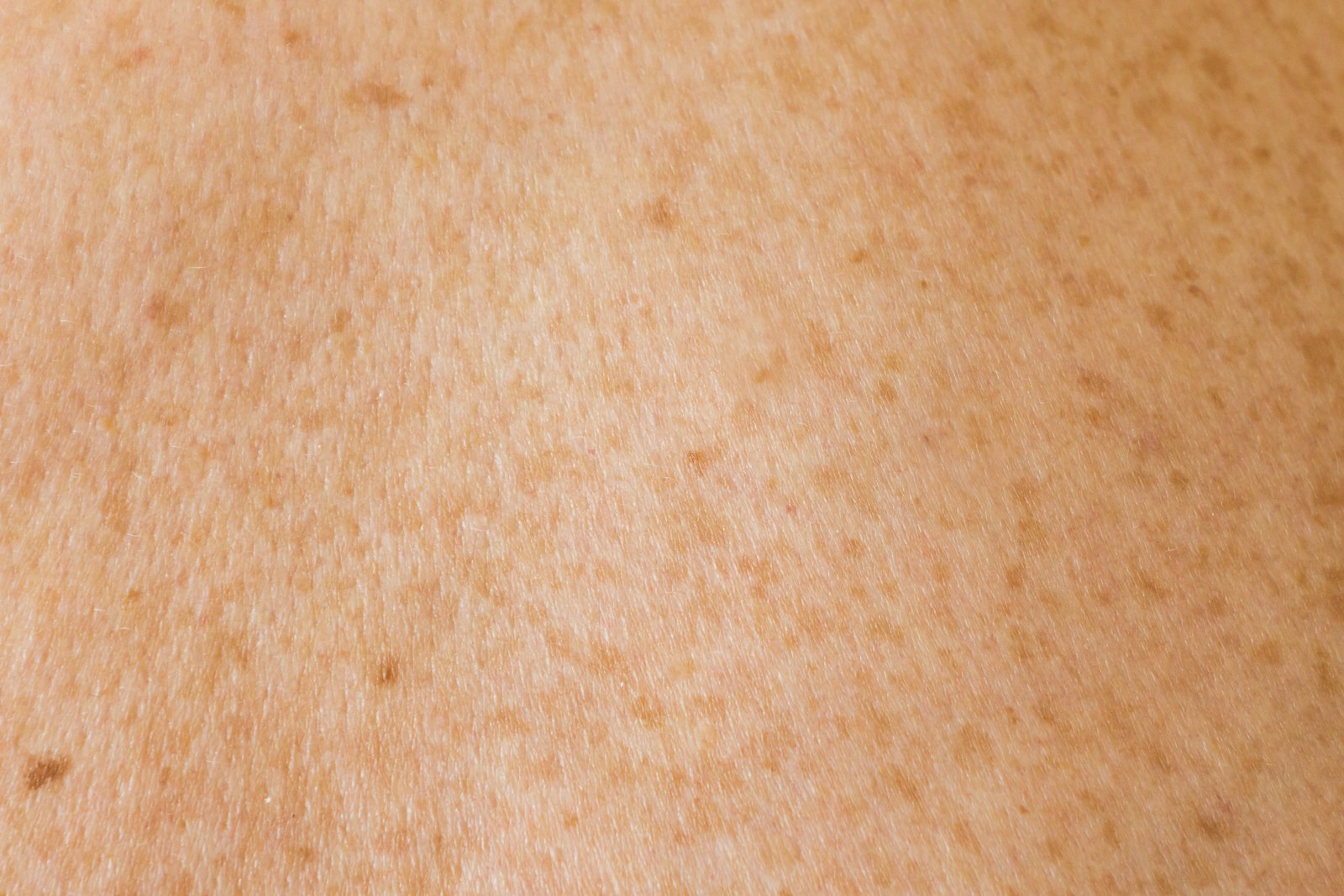 un gros plan du dos d’une personne avec des taches brunes