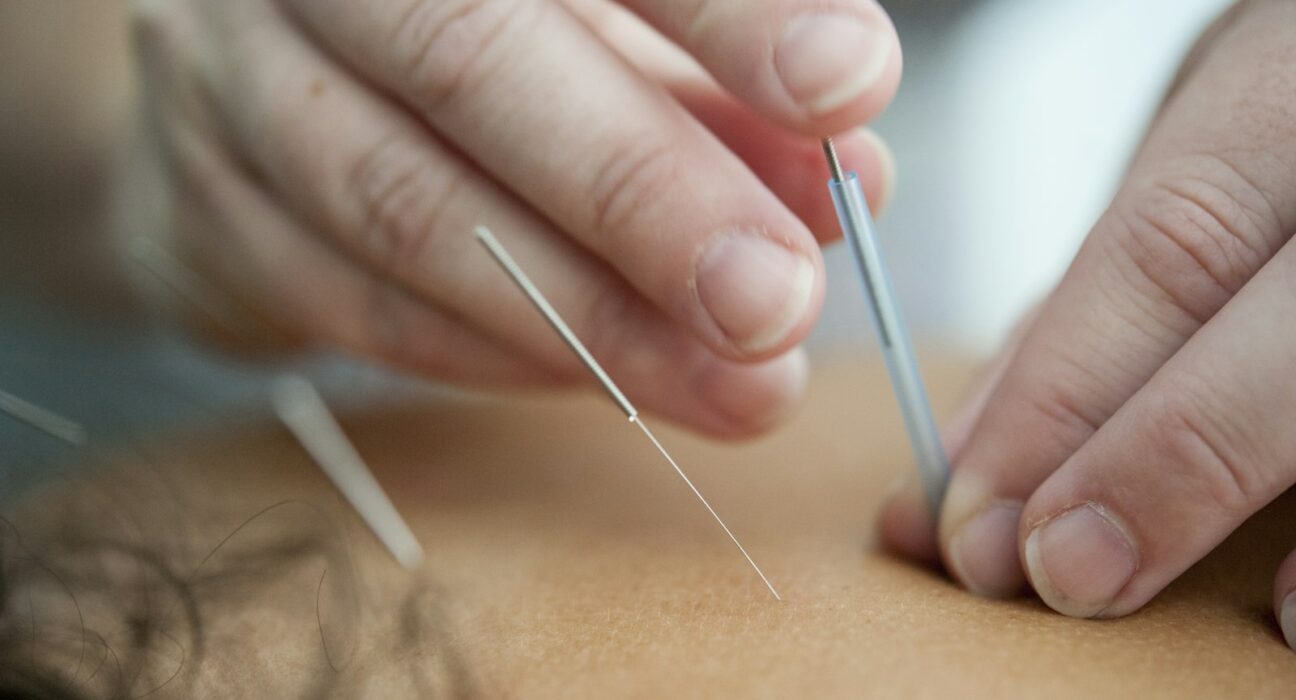 Aiguilles d’acupuncture insérées dans la peau