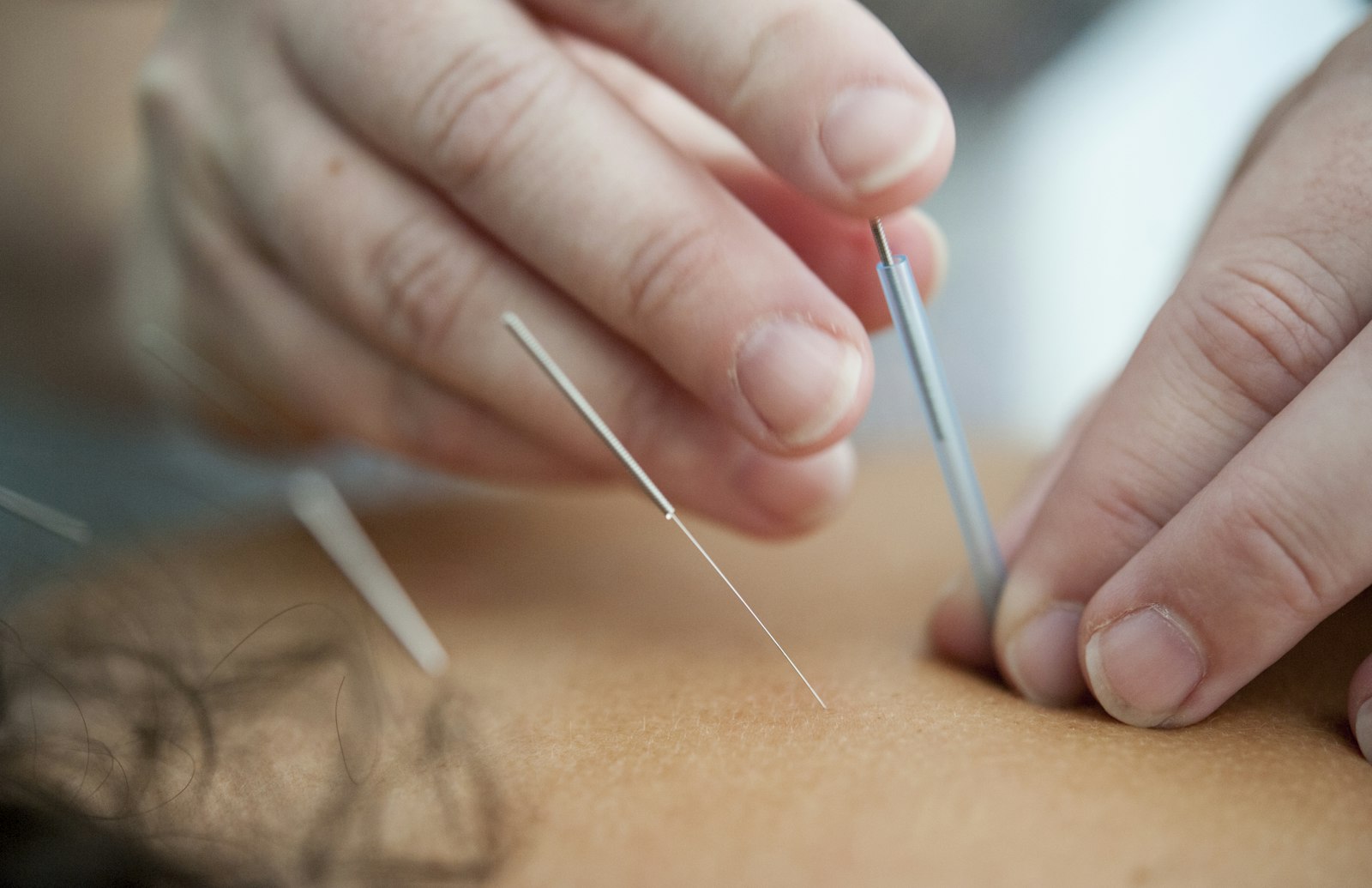 Aiguilles d’acupuncture insérées dans la peau